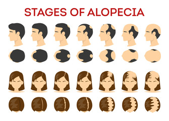Infographics of stages of Alopecia Universalis (AU)
