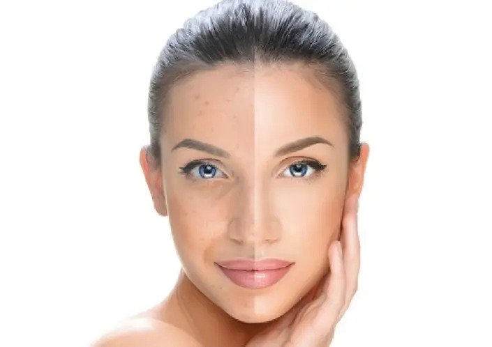 Skin pigmentation treatment in Pune at Arnica Clinic