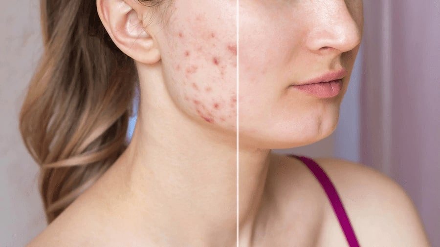 Acne treatment in Pune at Arnica Clinic