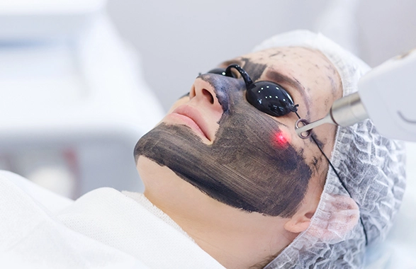 a lady is having Carbon Laser Peel Facial in Pune at Arnica Clinic