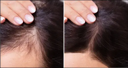 Hair transplant before- after