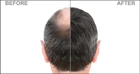 Hair transplant before- after