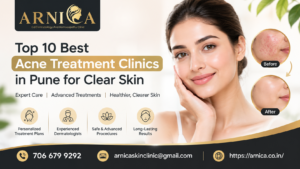 Acne Treatment Clinics in Pune